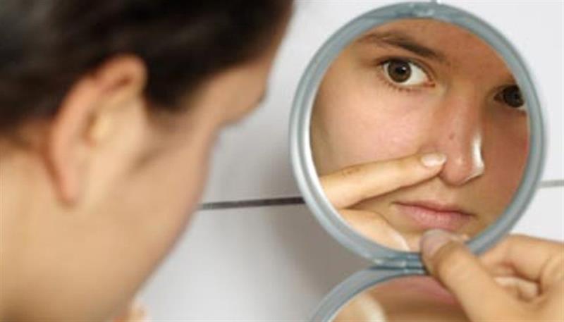 L'acne può essere occasionale o limitata ad alcuni periodi della vita
